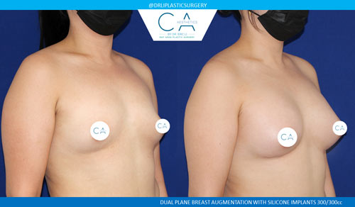 Tuberous Breast Correction case #3485