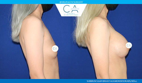 Asian Breast Augmentation case #2455