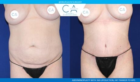 Tummy Tuck case #2558