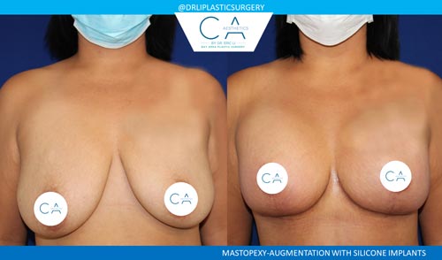 Breast Lift case #3512