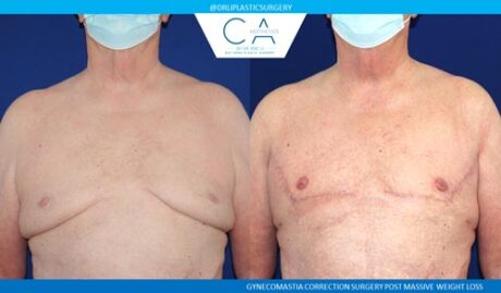 Gynecomastia case #2845