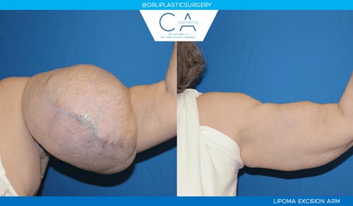 Mole Removal and Scar Revision case #3217