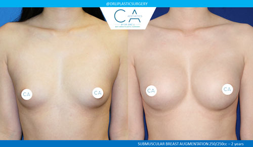 Asian Breast Augmentation case #2460