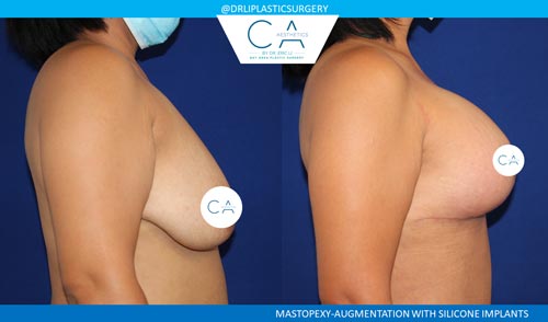 Breast Lift case #3512