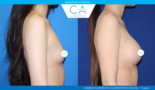 Asian Breast Augmentation case #2460