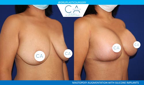 Breast Lift case #3512