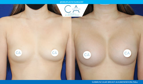 Asian Breast Augmentation case #2460