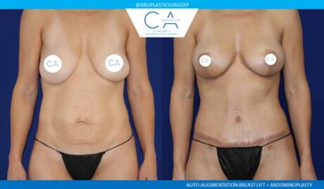 Tummy Tuck case #2562