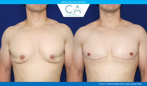 Gynecomastia case #2852