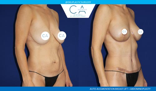 Tummy Tuck case #2562