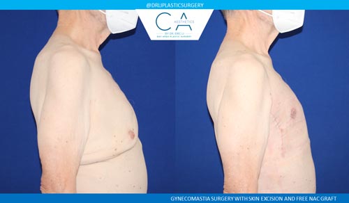 Gynecomastia case #2852