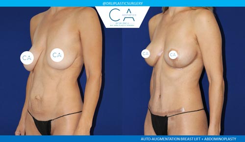 Tummy Tuck case #2562