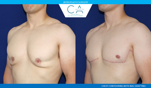 Gynecomastia case #2852