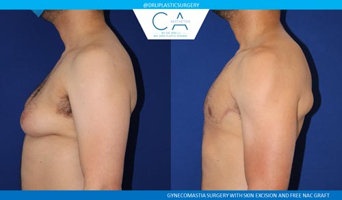 Gynecomastia case #2852