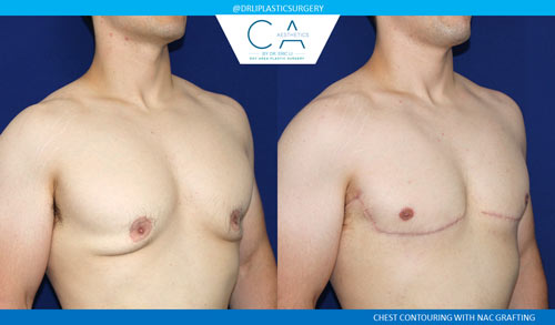 Gynecomastia case #2852