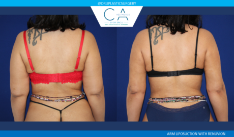 Arm Liposuction case #4572