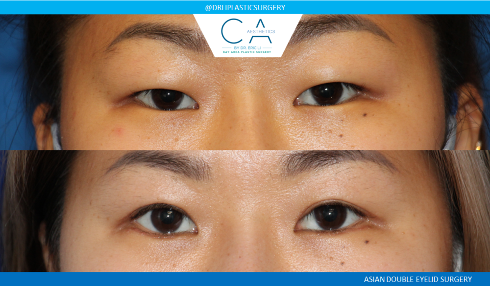 Asian Eyelid case #4602