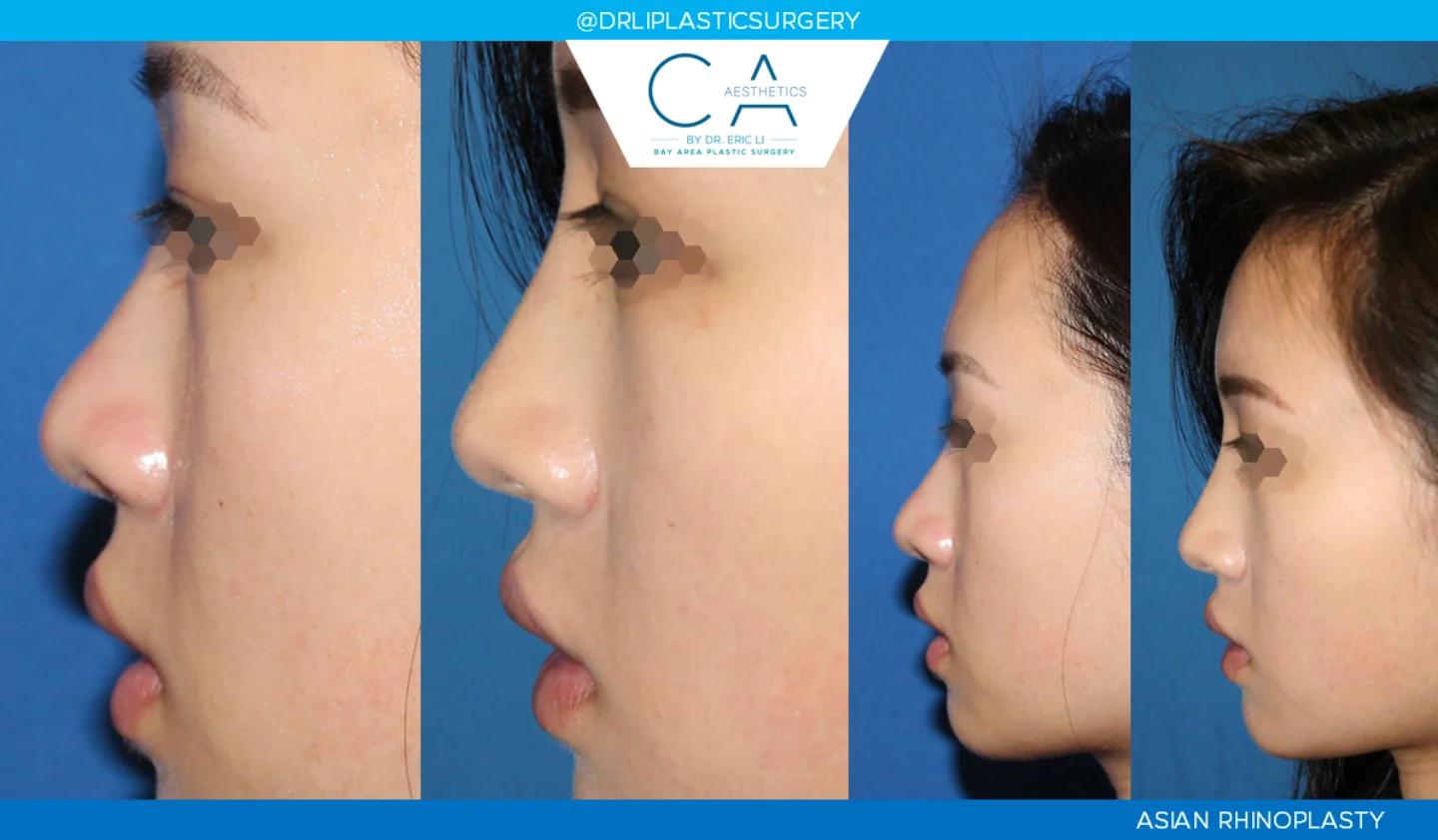 1 – Asian Filler Rhinoplasty Lateral