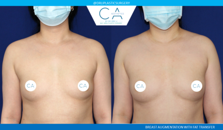 Fat Transfer Breast Augmentation case #4864