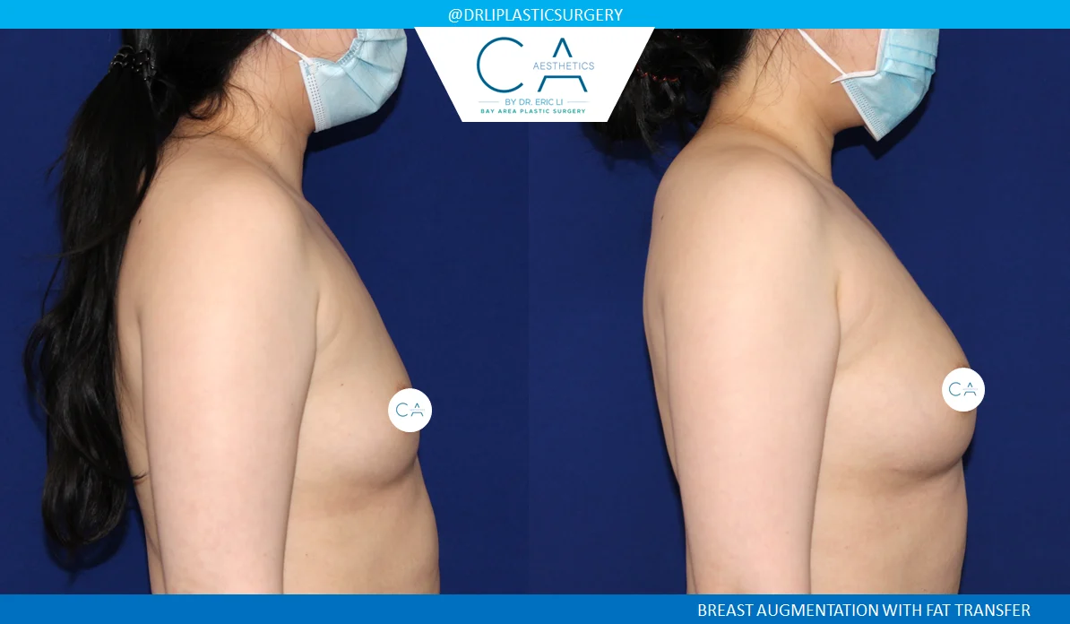 1 – Breast Augmentation Fat Transfer Only Lateral