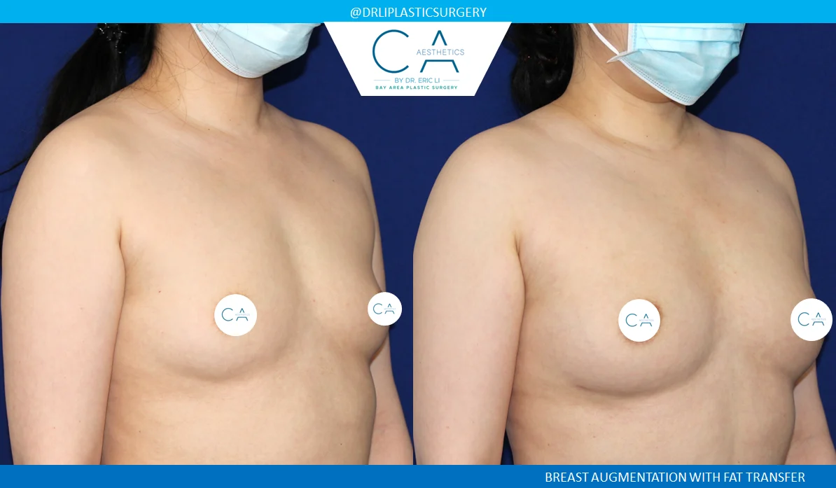 1 – Breast Augmentation Fat Transfer Only Oblique
