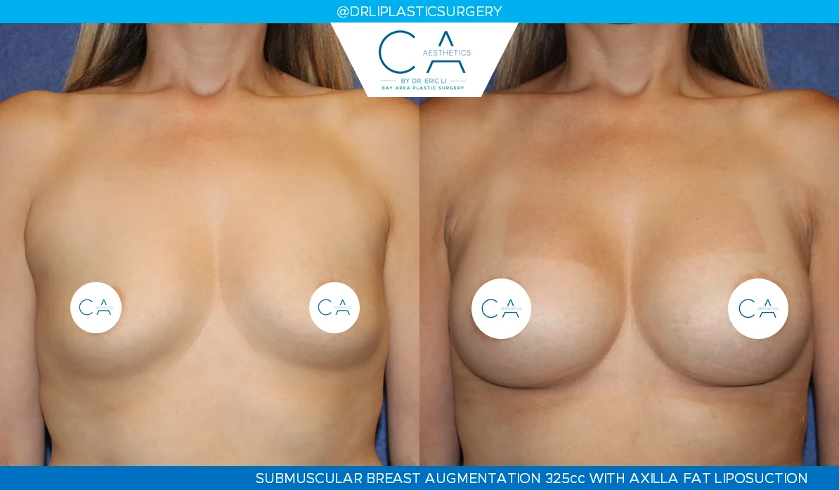 1 – Breast Augmentation Silicone Implants AP