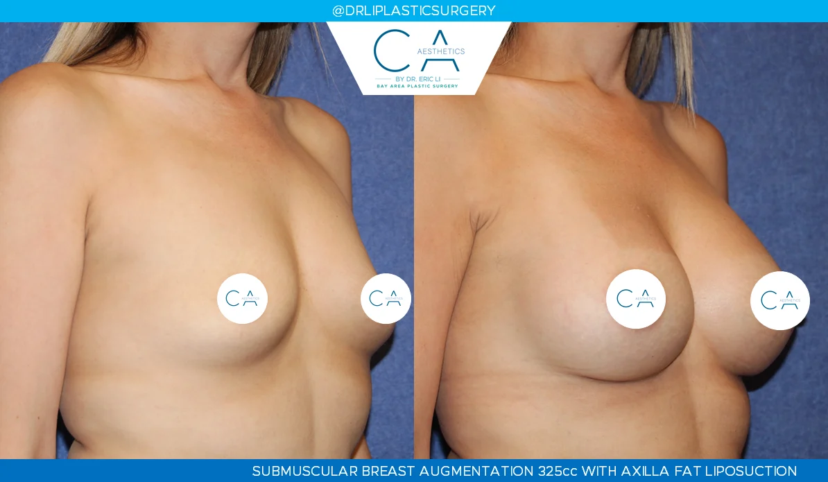 1 – Breast Augmentation Silicone Implants Oblique