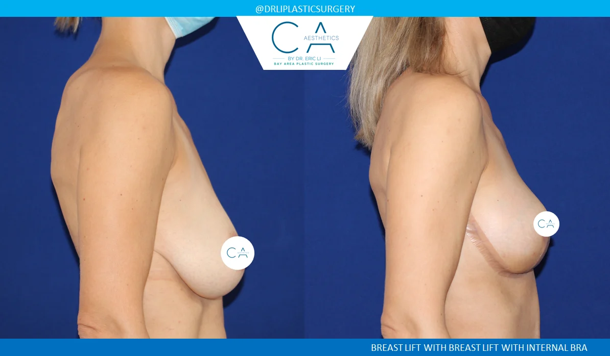 1 – Breast Lift Lateral