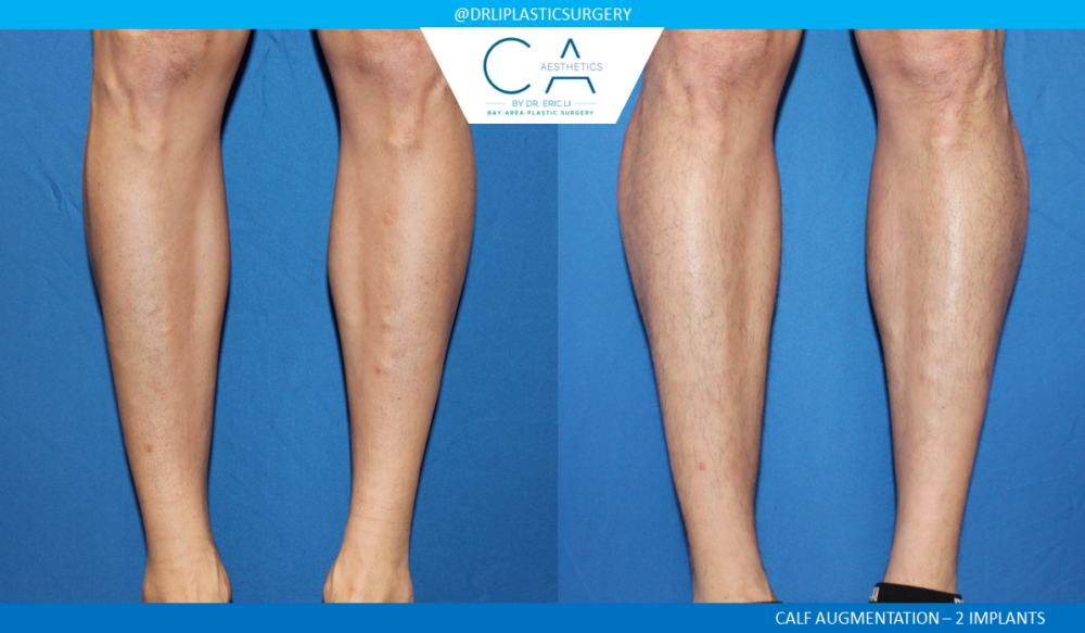 Body Augmentation case #4945