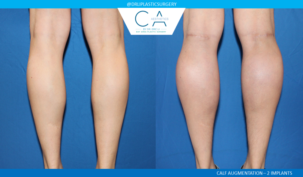 Body Augmentation case #4945