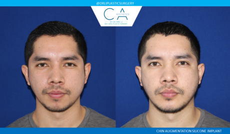 Facial Implants and Fat Transfer case #4765