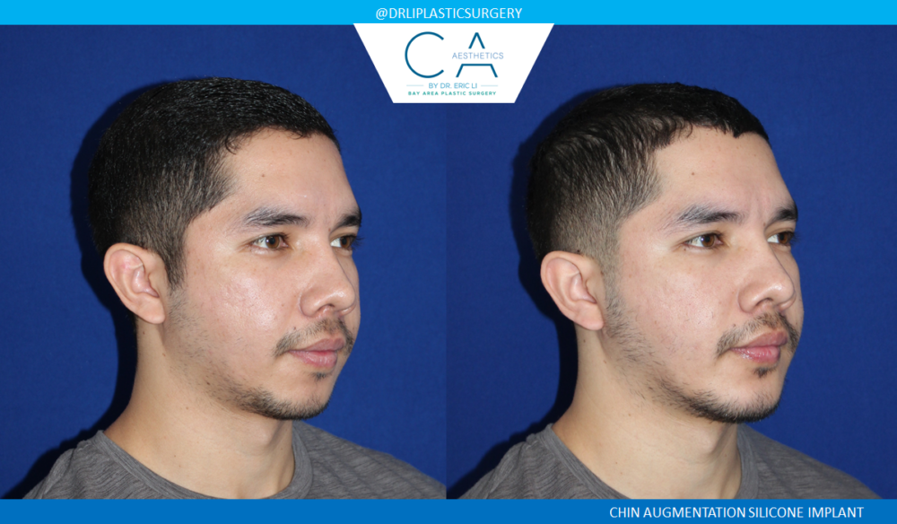 Facial Implants and Fat Transfer case #4765