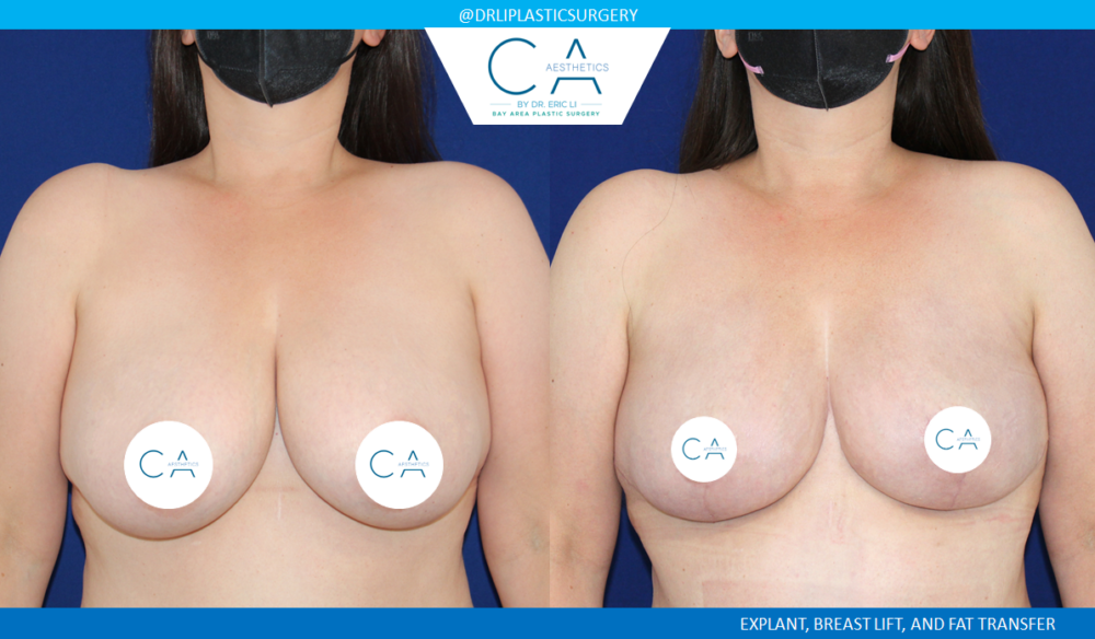 Breast Implant Removal case #4936