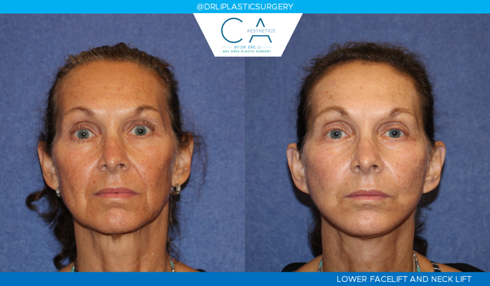 Facelift case #4786