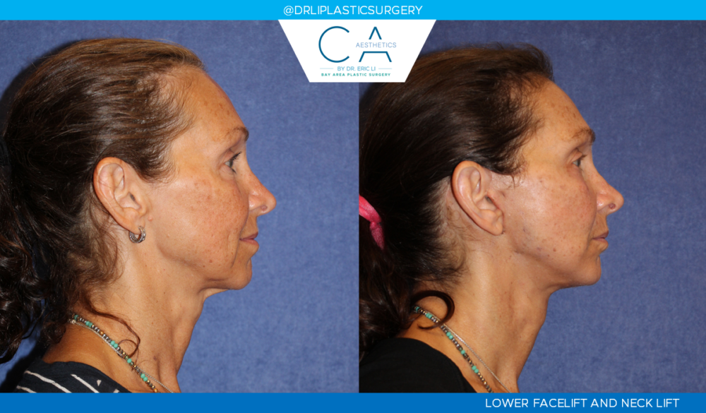 Facelift case #4786