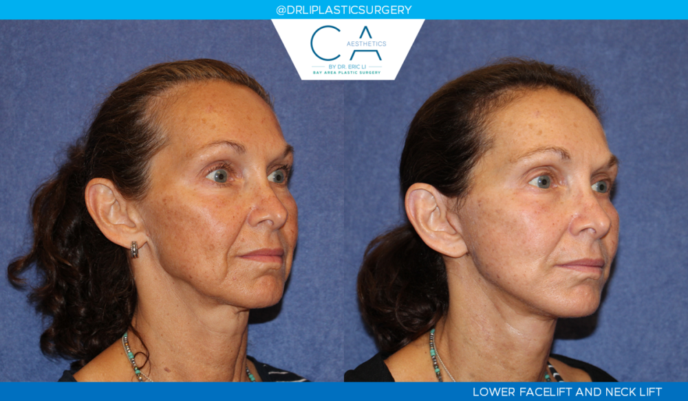 Facelift case #4786