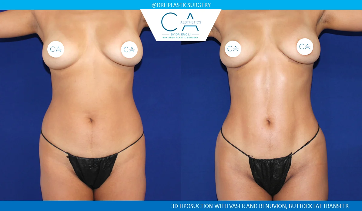 1 – High Definition Liposuction Abdomen and Back with VASER and Renuvion AP