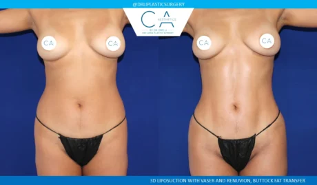 360 Liposuction (Torso) case #5532