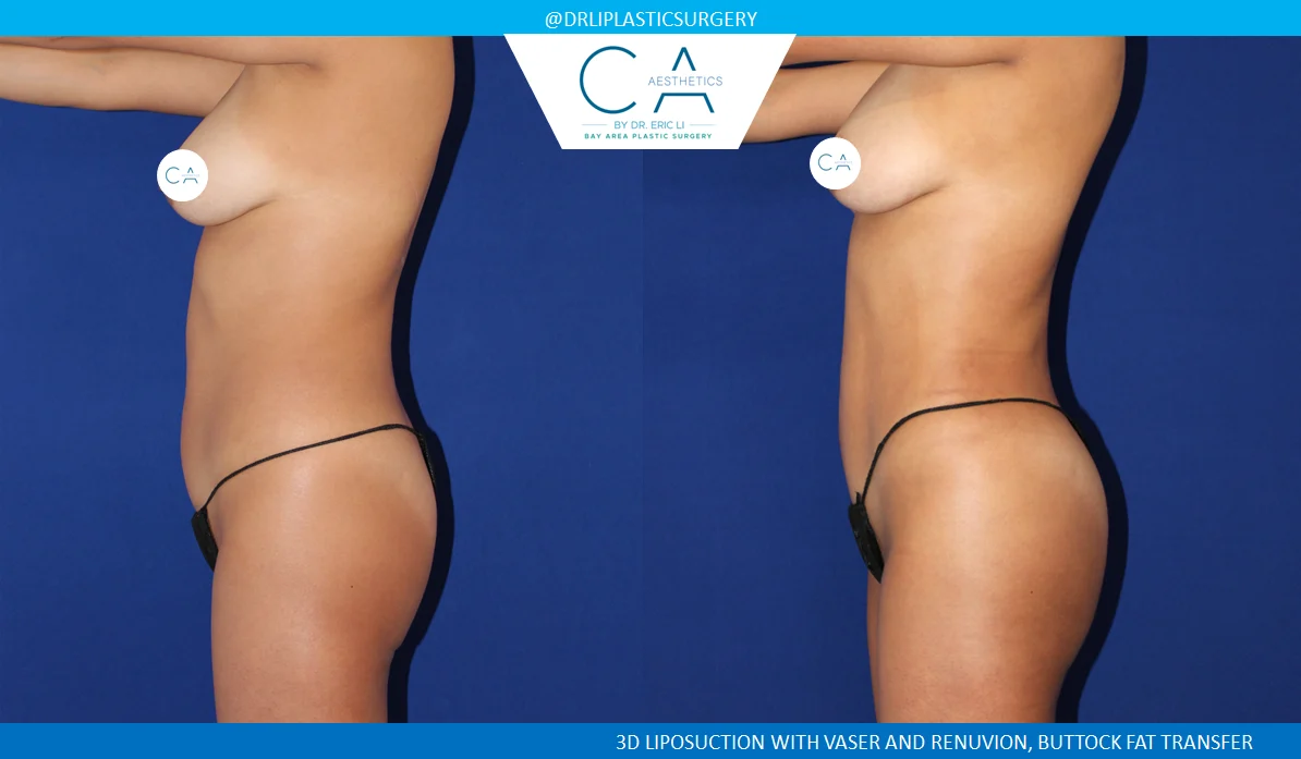 1 – High Definition Liposuction Abdomen and Back with VASER and Renuvion Lateral