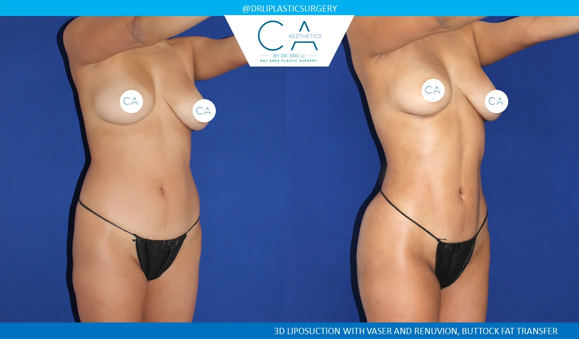 1 – High Definition Liposuction Abdomen and Back with VASER and Renuvion Oblique