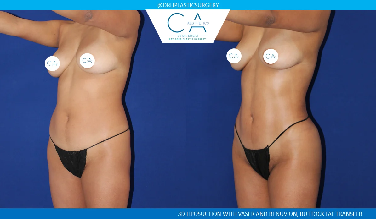 1 – High Definition Liposuction Abdomen and Back with VASER and Renuvion Oblique 2