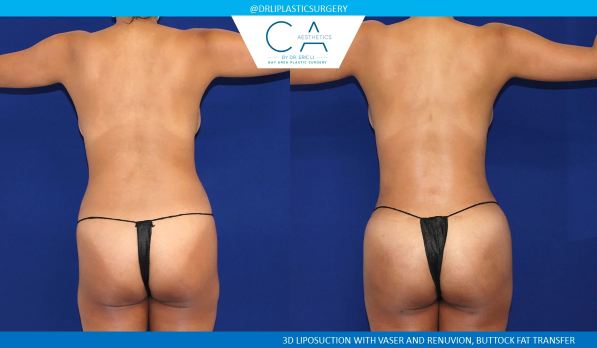 1 – High Definition Liposuction Abdomen and Back with VASER and Renuvion Posterior