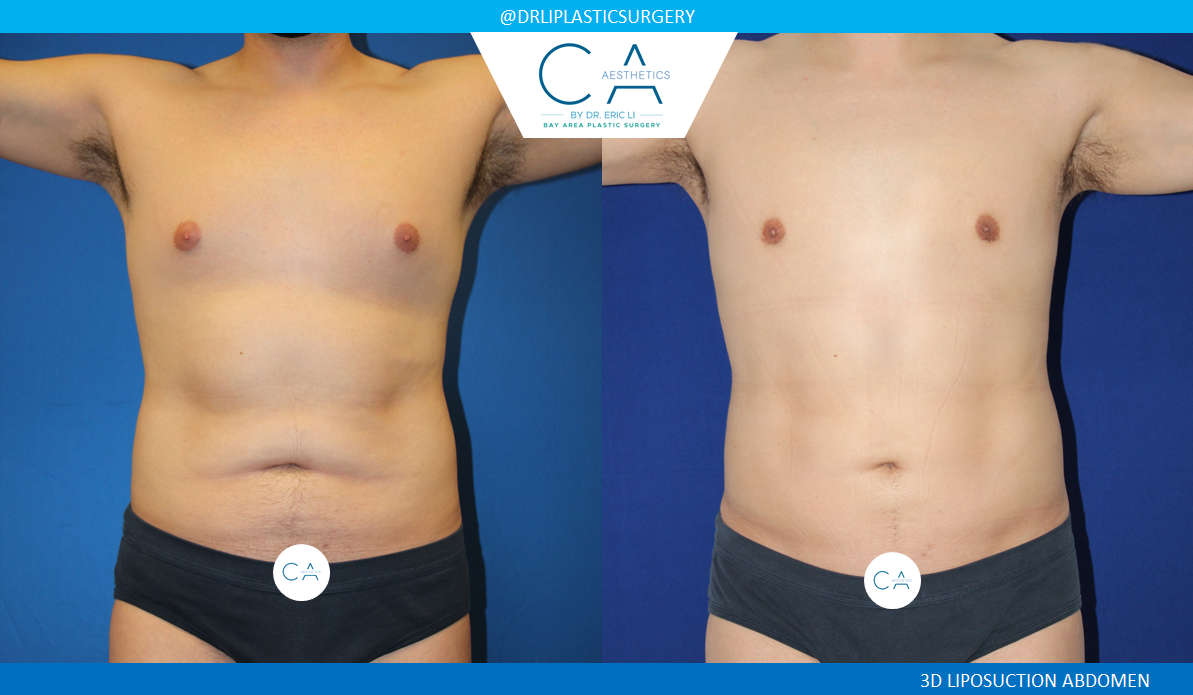 1 – Male Liposuction AP