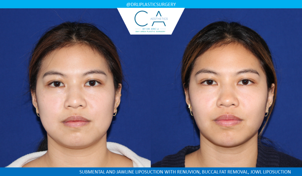 Face & Neck Liposuction case #4803