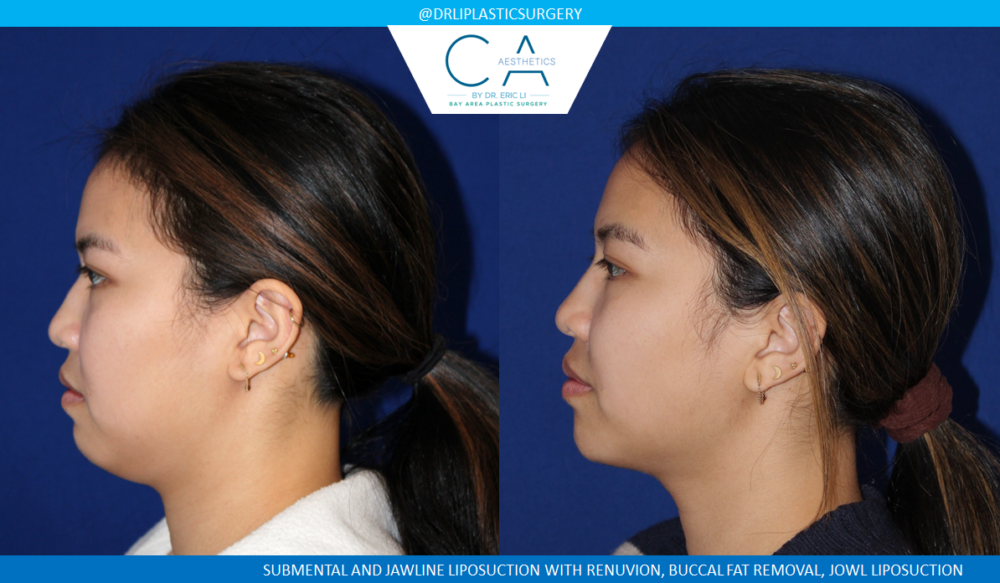 Face & Neck Liposuction case #4803