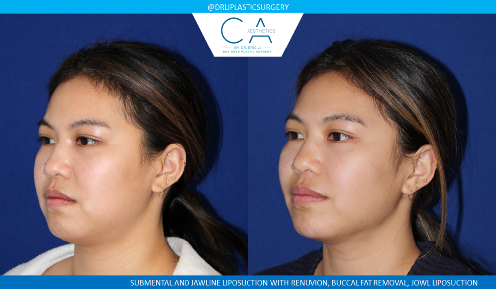 Face & Neck Liposuction case #4803