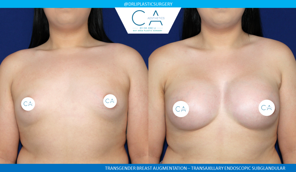 Transaxillary Breast Augmentation case #4999