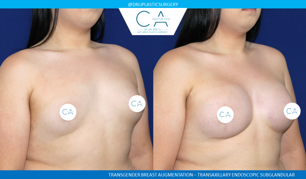 Transaxillary Breast Augmentation case #4999