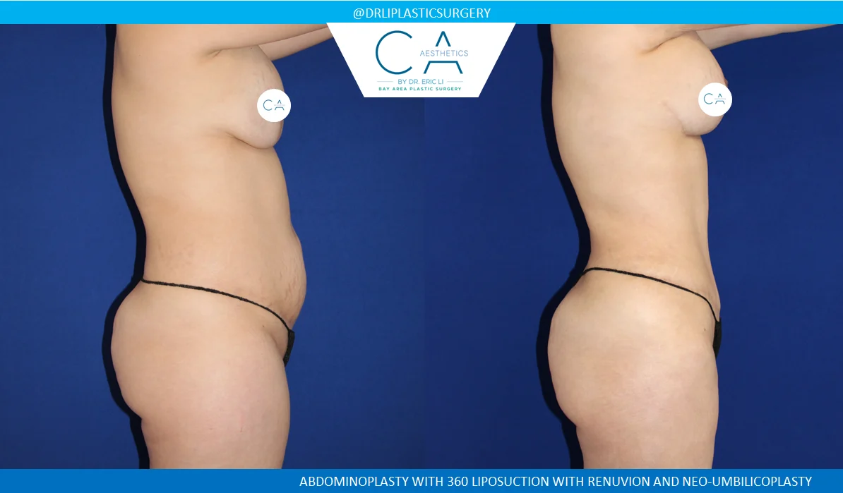 1 – Tummy Tuck Lateral