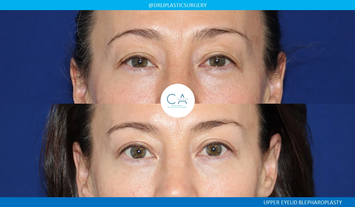 1 – Upper Eyelid Surgery AP